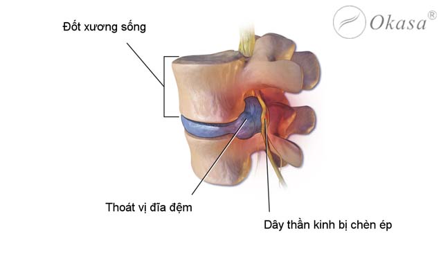 Thoát vị đĩa đệm lưng gây chèn ép rễ thần kinh