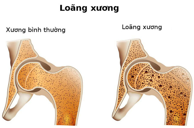 Thời điểm uống canxi giúp hấp thu tốt, ngừa loãng xương