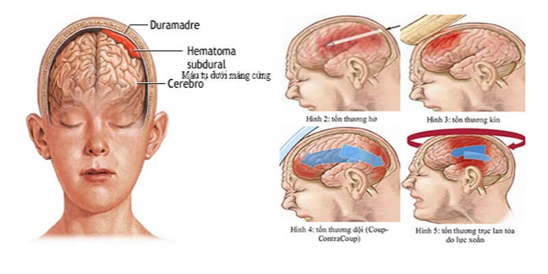 thường xuyên đau đầu có thể là triệu chứng của bệnh gì