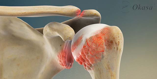 Tìm hiểu bệnh khớp cùng vai đòn bị thoái hóa