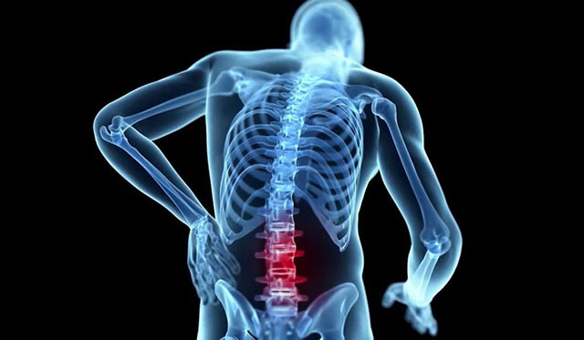 Tìm hiểu bệnh lao cột sống