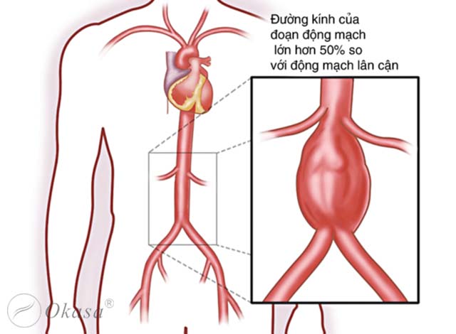 Tìm hiểu bệnh phình động mạch chủ bụng