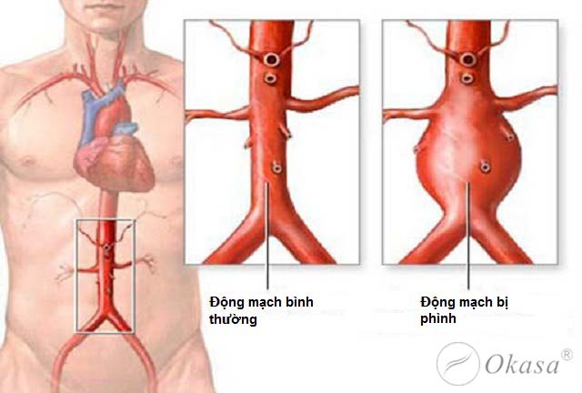 Tìm hiểu bệnh phình động mạch chủ bụng