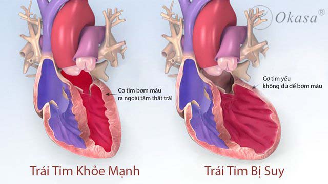 Tìm hiểu bệnh suy tim tâm trương