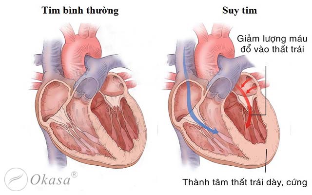 Tìm hiểu bệnh suy tim tâm trương