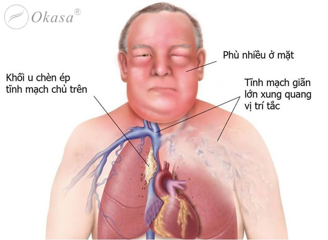 Tìm hiểu thông tin về hội chứng tĩnh mạch chủ trên