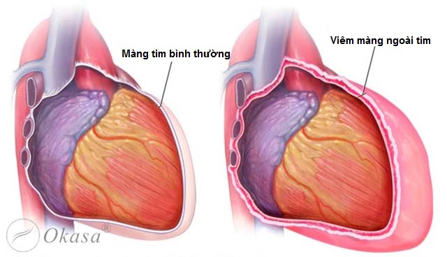 Tìm hiểu về bệnh viêm màng ngoài tim cấp