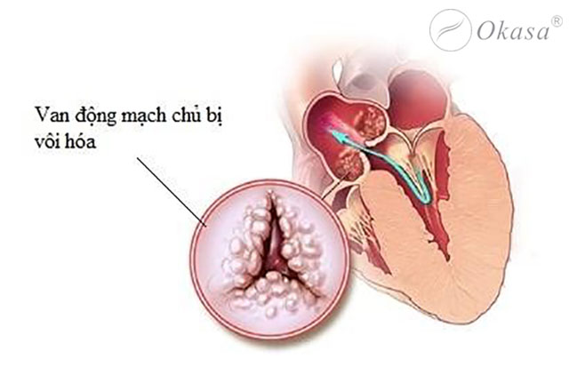 Tìm hiểu về tình trạng mạch vành bị vôi hóa