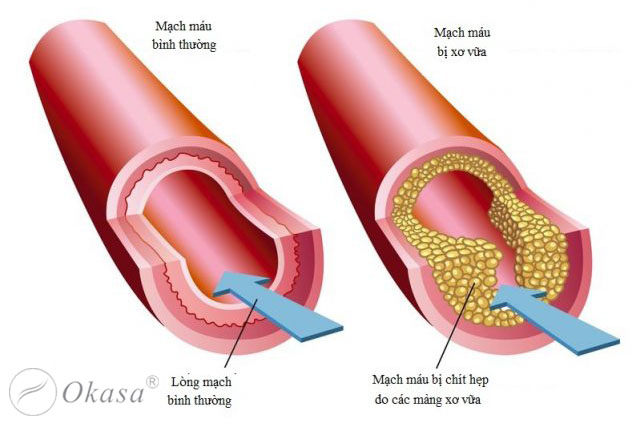 Tìm hiểu về tình trạng mạch vành bị vôi hóa