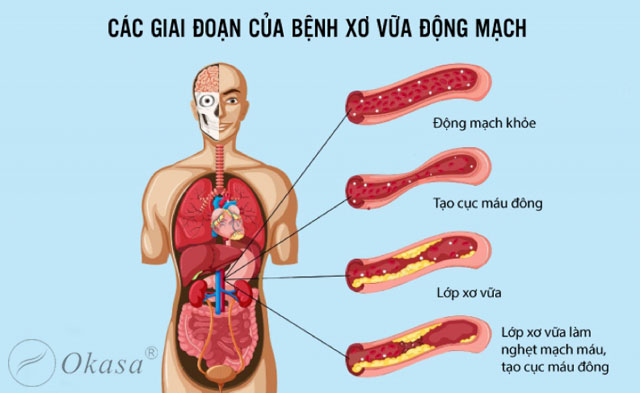 Tìm hiểu về tình trạng mạch vành bị vôi hóa