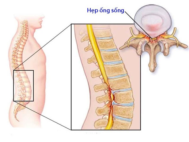 tình trạng đau lưng dưới gần mông là bệnh gì