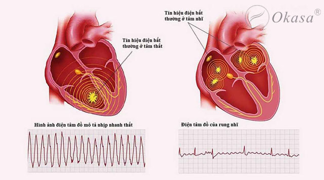 Tình trạng rung nhĩ và những điều cần biết