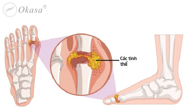 Tổn thương viêm khớp và viêm quanh khớp