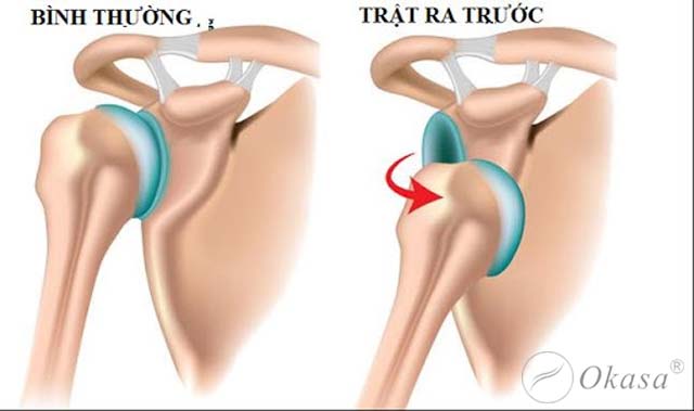 Trật khớp vai có thể bị tái lại