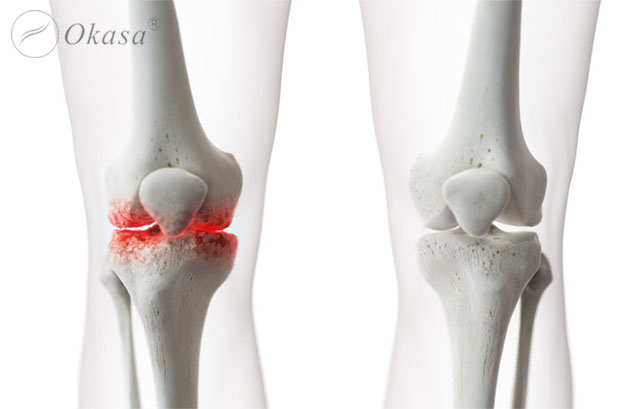 Trị liệu giảm đau do thoái hóa khớp gối