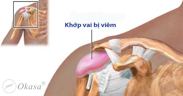 Triệu chứng bệnh viêm dính bao khớp vai