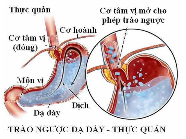 triệu chứng buồn nôn vào buổi sáng có nguy hiểm không
