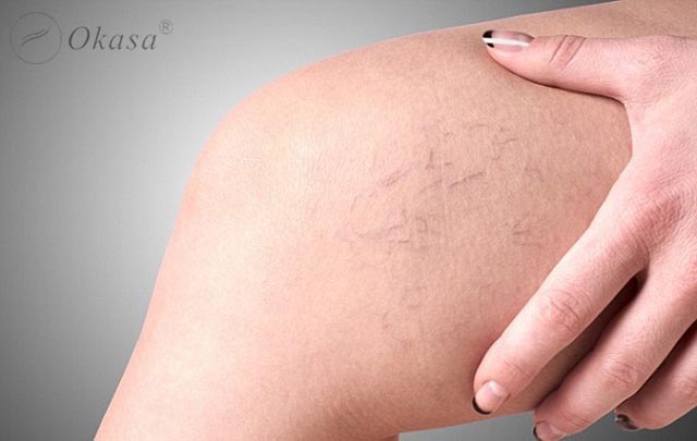 Triệu chứng và điều trị suy van tĩnh mạch sâu