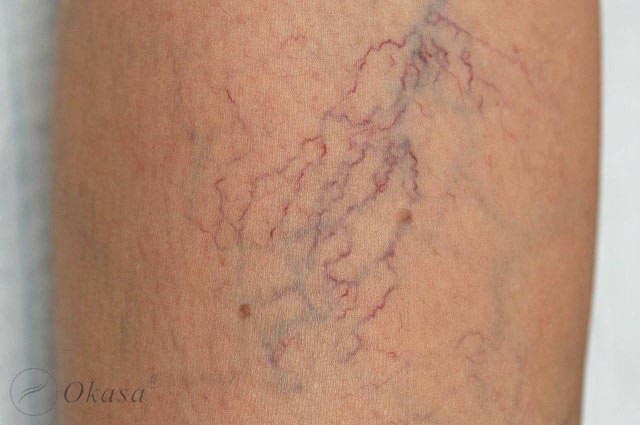 Triệu chứng và điều trị suy van tĩnh mạch sâu