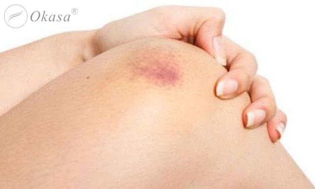 Triệu chứng và điều trị suy van tĩnh mạch sâu