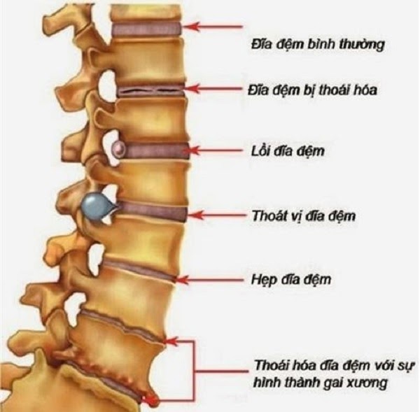 triệu chứng đau lưng do cột sống