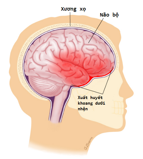Triệu chứng đau nửa đầu sau gáy có nguy hiểm không