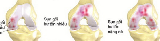 triệu chứng giãn dây chằng đầu gối