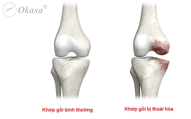Triệu chứng sưng, nóng, đỏ, đau tại khớp nói lên điều gì?