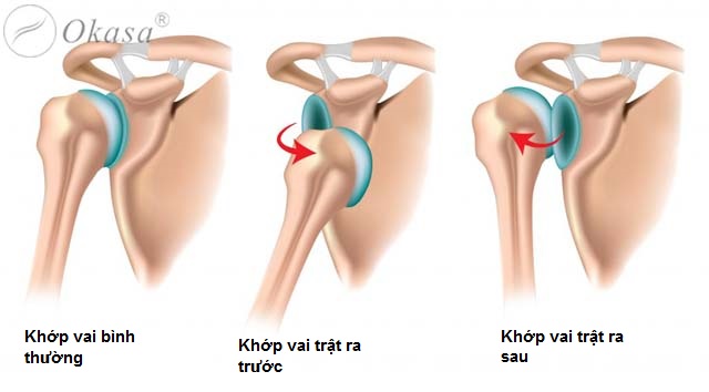 Triệu chứng và biến chứng của trật khớp vai