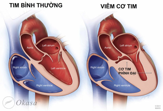 Triệu chứng và chẩn đoán viêm cơ tim cấp do virus