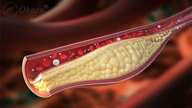 Triệu chứng xơ vữa động mạch