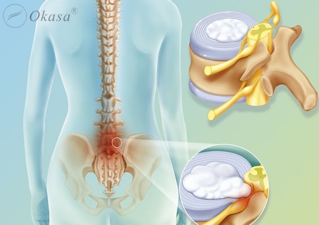 Vận động trị liệu khi bị thoát vị đĩa đệm