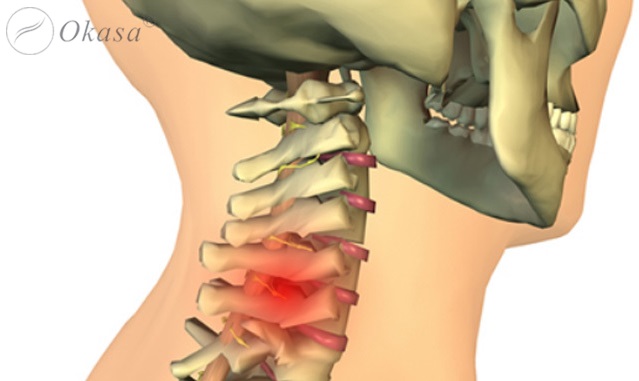 Vật lý trị liệu cho người thoát vị đĩa đệm