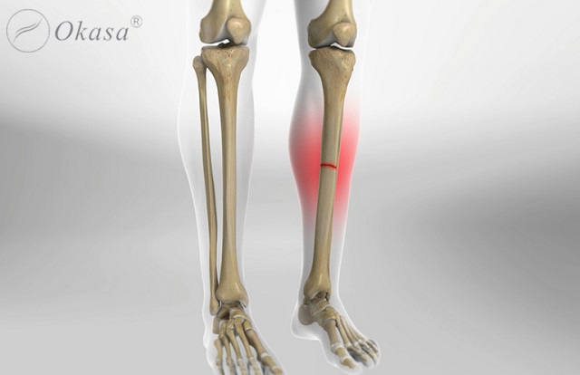 Vật lý trị liệu sau gãy xương giúp phục hồi chức năng