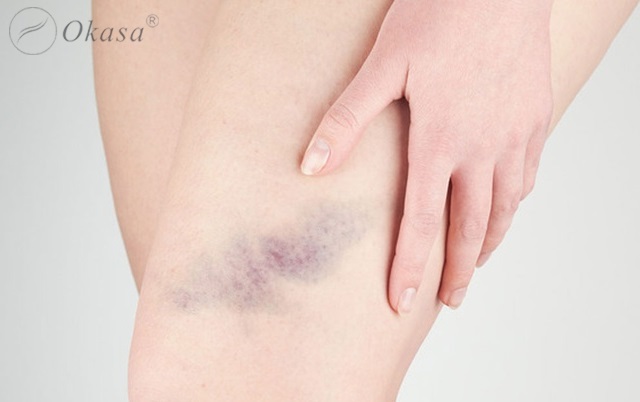 Vết bầm tím: Nguyên nhân, triệu chứng và cách xử lý?