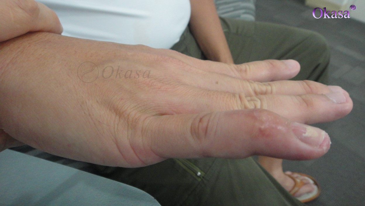 viêm bao khớp ngón tay