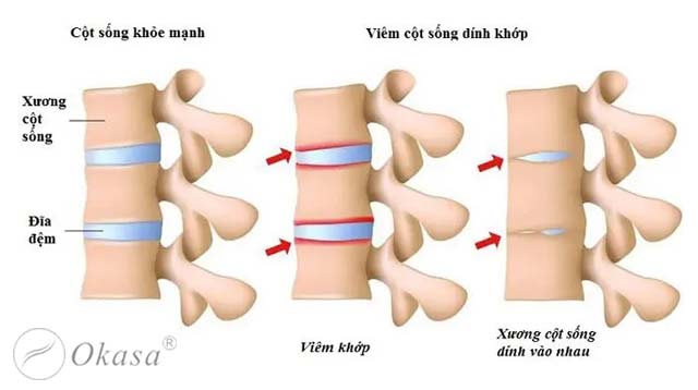Viêm cột sống dính khớp: Chẩn đoán và điều trị
