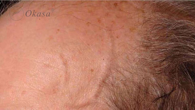 Tìm hiểu bệnh viêm động mạch tế bào khổng lồ