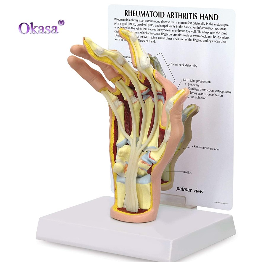 viêm khớp dạng thâp