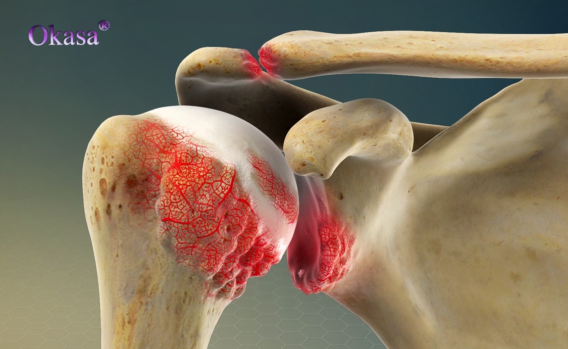 viêm khớp dạng thấp