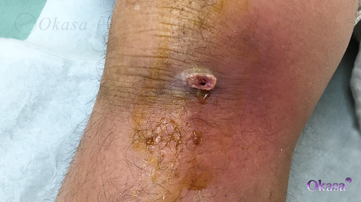 viêm khớp nhiễm khuẩn chân