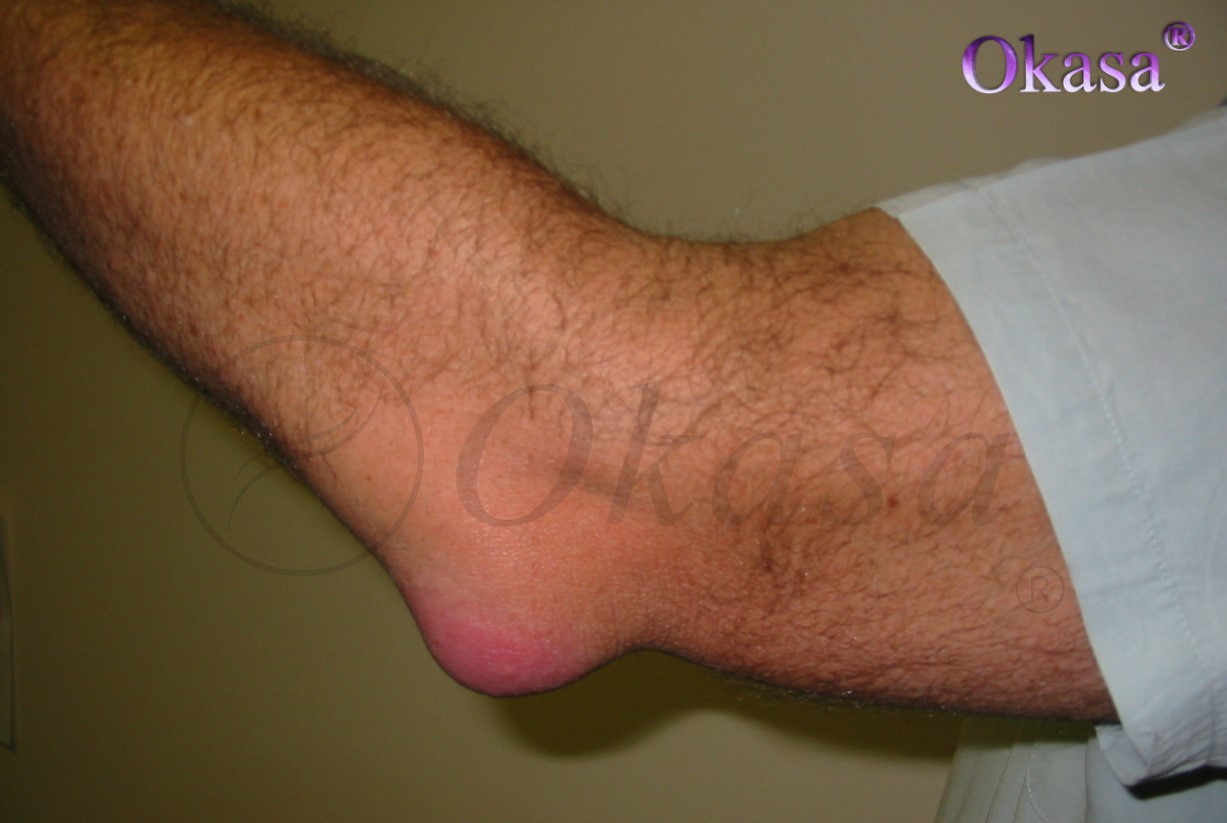 viêm khớp nhiễm khuẩn tay