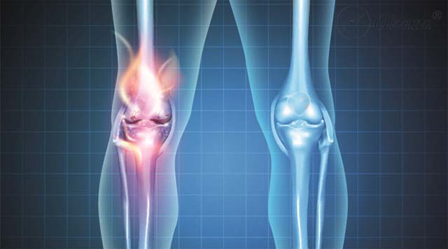 Viêm khớp phản ứng do tác nhân nào gây ra?