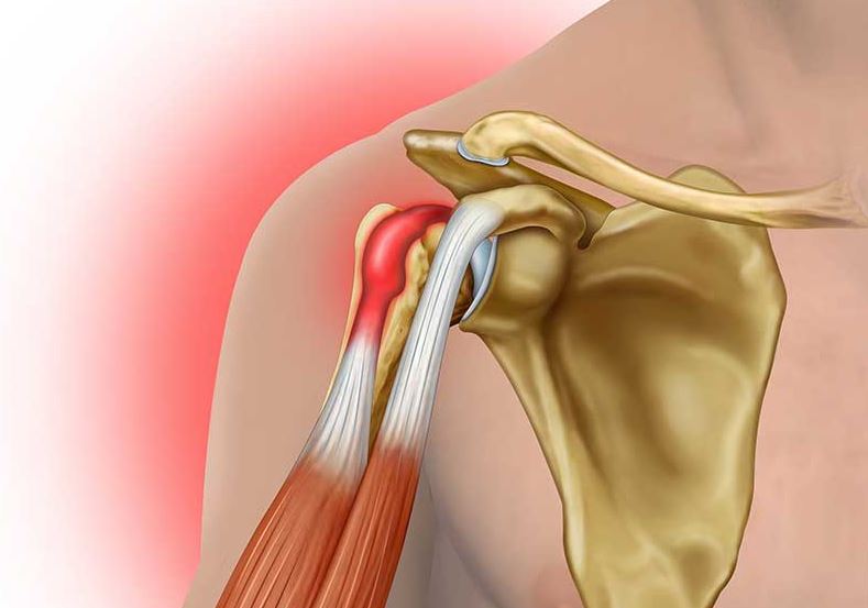 viêm khớp quanh vai