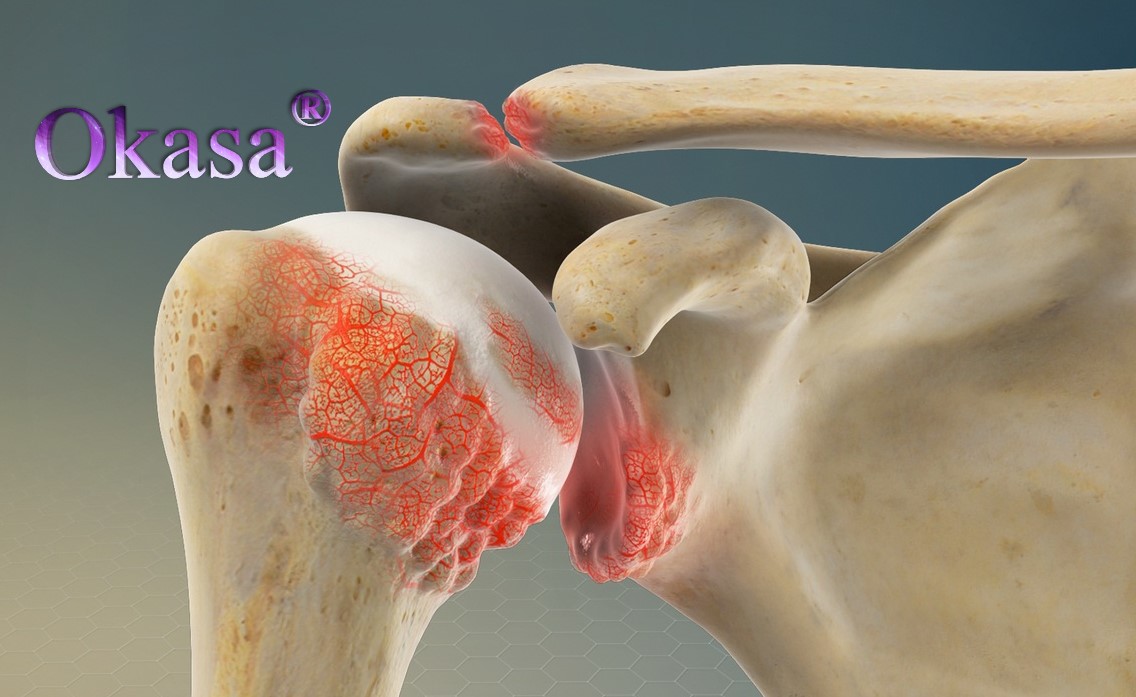 viêm khớp quanh vai