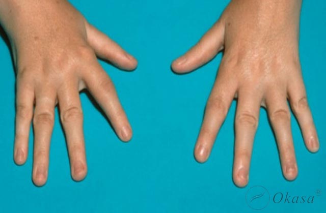 Viêm khớp thiếu niên tự phát: Phân loại và đặc điểm