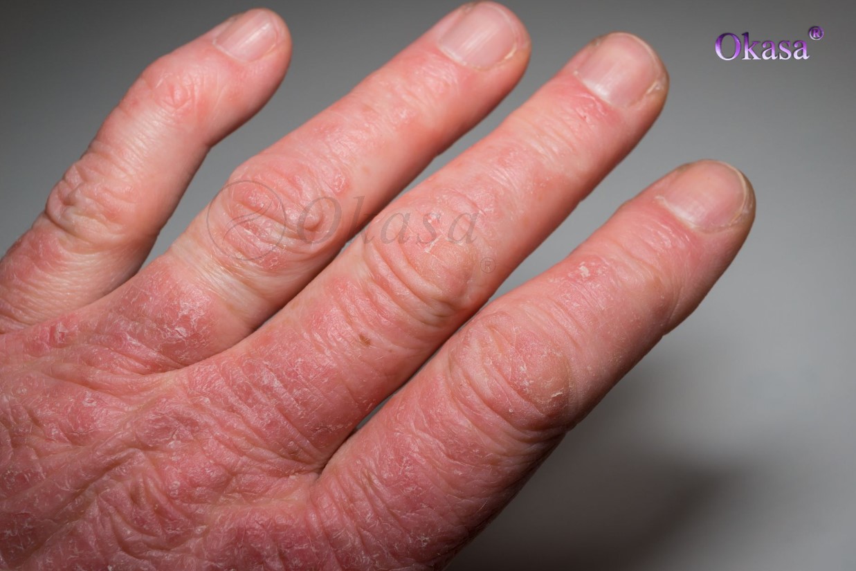 viêm khớp vảy nến