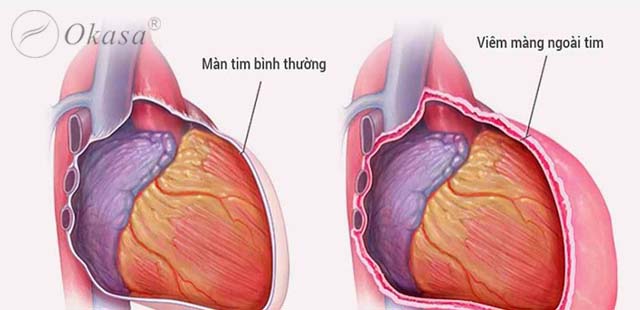 Viêm màng ngoài tim gây biến chứng gì?