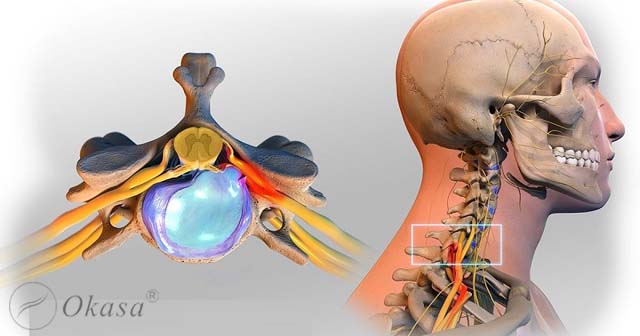xep-dia-dem-va-nguyen-nhan-gay-benh-2