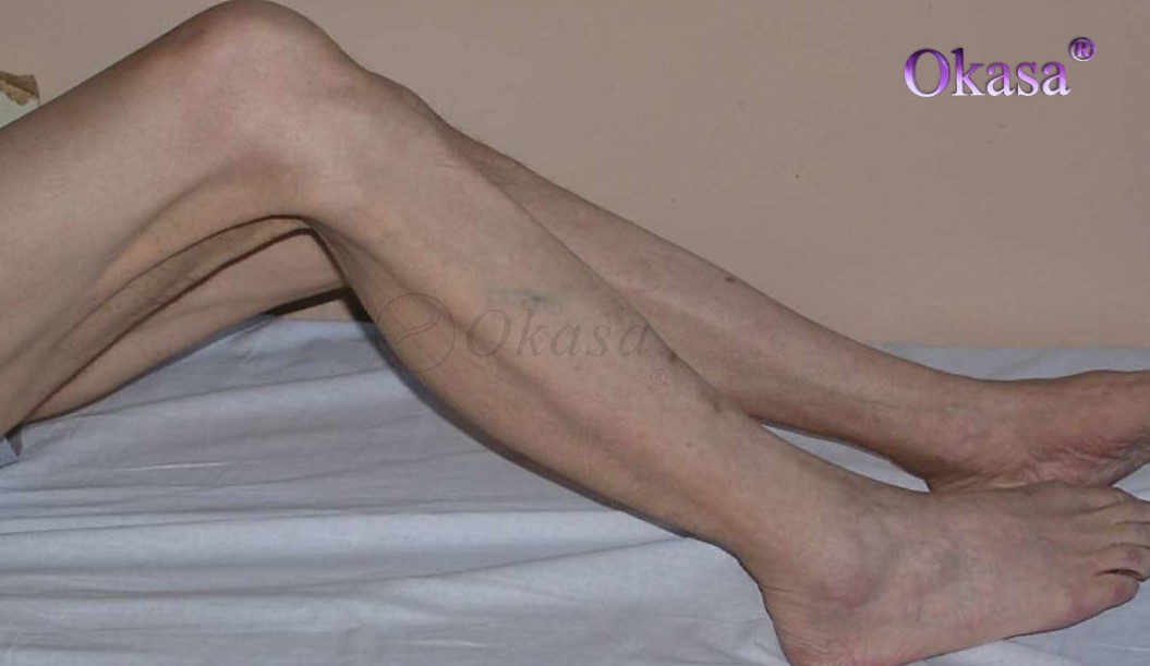 xơ cứng teo cơ